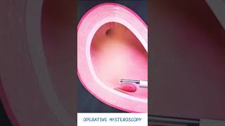 Operative Hysteroscopy  Fibroid amp Polyp removal  Hysteroscopic polypectomy  Types of Hysteroscope [upl. by Elleina645]