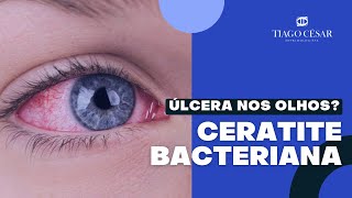 ÚLCERA NOS OLHOS  Ceratite bacteriana  Úlcera de córnea [upl. by Ahsemot]