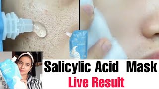 Salicylic Acid Ice Cream Mask Removeopen porse Acne  Pimples Black Heads  Honest Review  Demo [upl. by Enilorak]