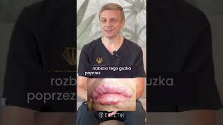 Powikłanie guzki po kwasie hialuronowym dr Marek Wasiluk estetikpl estetik [upl. by Lednahs818]