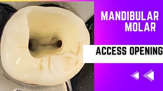 Mandibular Molar Access Opening [upl. by Dinse493]