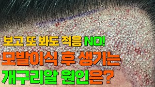 모발이식 개구리알 원인은비절개 대량모발이식 노블라인 모발이식센터 [upl. by Voe]