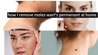 How to remove moles  get rid of mole on skin  remove moles permenant at home [upl. by Nyltyak]