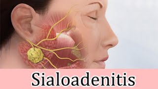 Sialoadenitis inflamación sublingual granos rojos tratamiento [upl. by Hendren]