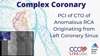 PCI of CTO of Anomalous RCA Originating from Left Coronary Sinus  March 18 2014 Webcast Video [upl. by Ybbor]