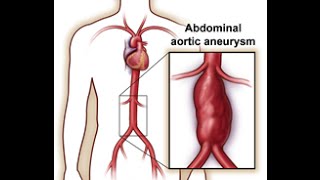 Abdominal Aortic Aneurysm AAA [upl. by Assilym959]