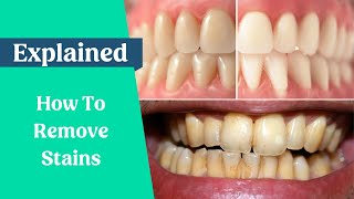 How to remove stains from the teeth [upl. by Dnalkrik]