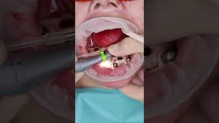 Dental implant’s All on 4 in Prague shorts dentist dental implant veneers short [upl. by Groot]