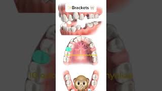 Second premolars extraction orthodontie kieferorthopädie orthodontics ortodonzia ortodoncia [upl. by Morry510]