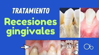 RECESIONES GINGIVALES causas y tratamiento encías retraídas [upl. by Ahsieat4]