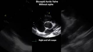 Bicuspid Aortic Valve [upl. by Ehcor]