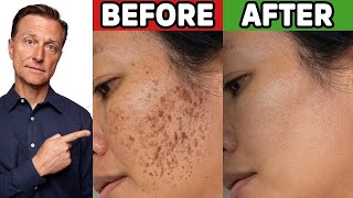 How to Get Rid of Hyperpigmentation Aging or Dark Spots [upl. by Rediah803]