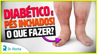 Diabético com PÉS INCHADOS O que fazer 🦶🏼🚫 [upl. by Nichole859]