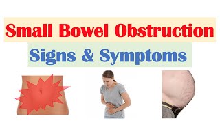 Small Bowel Obstruction SBO Signs amp Symptoms amp Why They Occur [upl. by Christa]