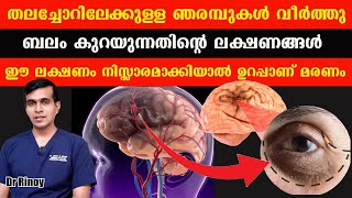 തലച്ചോറിലേക്കുള്ള ഞരമ്പുകൾ വീർത്തു ബലം കുറയുന്നതിന്റെ ലക്ഷണങ്ങൾ ഈ ലക്ഷണം നിസ്സാരമാക്കിയാൽ Dr Rinoy [upl. by Zampardi]