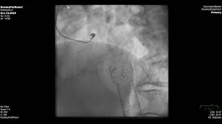 Myocardial bridging [upl. by Ahseela]