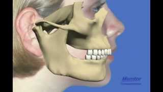 Herbst appliancemove lower jaw forward [upl. by Yesnik239]