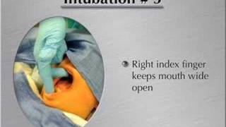 IntubationHow to perform endotracheal intubation 1 [upl. by Nedle349]