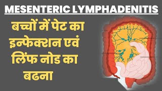 MESENTRIC LYMPHADENITIS in Hindi । बच्चों में पेट का इन्फेक्शन । लिंफ नोड का बढना [upl. by Zoller986]