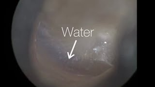 30  Shower Water Trapped in Ear Microsuctioned using the WAXscope®️ [upl. by Llewkcor]