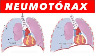 DESCOMPRESIÓN URGENTE 💉Caso clínico real‼️😱🫁 [upl. by Westhead]