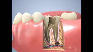 La dévitalisation dentaire [upl. by Khichabia]