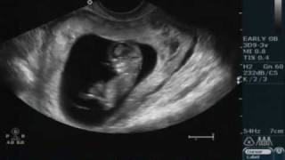 11 week ultrasound [upl. by Elad]