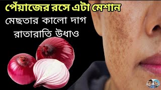 পেঁয়াজের রসে কি মেশালে খুব তাড়াতাড়ি মেছতা দূর হয়ে দাগহীন ফর্সা ত্বক পাবেনmesta dur korar upay [upl. by Mateusz738]