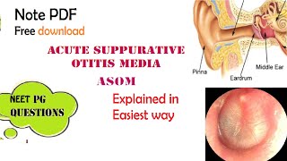 Acute Suppurative Otitis Media  ASOM  ENT  Easy explanation  Stages  Diagnosis  Management [upl. by Snilloc]