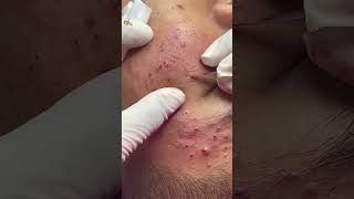 Best Pimple Popping 04 beautiful blackheads sacdepspa [upl. by Niamrahc]