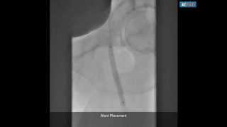 Viance Subintimal Reentry and Stenting for Mid SFA CTO [upl. by Nylareg]