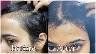 Best Hair Serums For Reduced Hair fall and Hair Growth [upl. by Benetta]