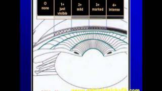 Gonioscopy Lecture part 07 [upl. by Aikrehs]