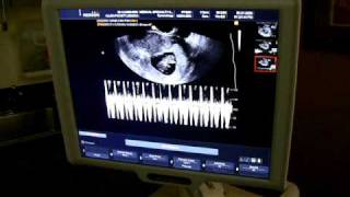 Baby Heartbeat Video from Ultrasound [upl. by Leak]