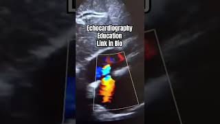 Patent foramen ovale echocardiography [upl. by Iruj]