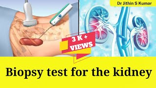 Biopsy test for the kidney in Malayalam Renal Biopsy [upl. by Swartz]