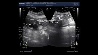 Ultrasound Video showing Renal Angiomyolipoma and ureteral stone [upl. by Pfeifer]