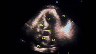 Tamponade echo to drahmadmirdamadisil3PboCd7Rn3QHdb [upl. by Alleber]