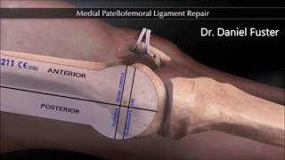 Reconstrucción ligamento patelofemoral medial [upl. by Arahsak]