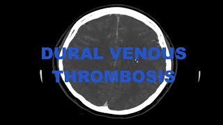 Clinical case  Dural venous sinus thrombosis and cortical venous thrombosis with infarct [upl. by The]