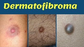 Dermatofibroma treatment hard bump on leg  चमड़ी में सख़्त गाँठ का कारण  इलाज  Dr Uttam Lenka [upl. by Merrill395]