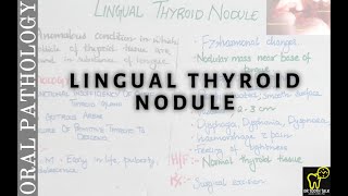 Lingual Thyroid Nodule  Developmental Disturbances Of Tongue Part 8 [upl. by Bernhard288]