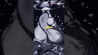 Understanding Mitral Regurgitation mitralvalve regurgitation heartvalve cardiology medstudent [upl. by Annora]