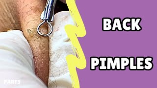 Extraction of back pimplesRelax with bye pimple💜pimple blackheads acne asmr [upl. by Aihseken]