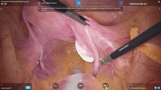 VirtaMed LaparoS™  Treatment of Adnexa with Adnexectomy [upl. by Per]