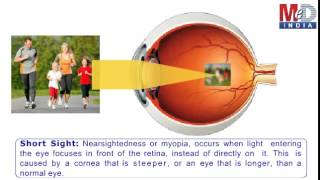 How To Correct ShortSightedness [upl. by Schaffer]