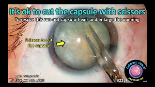 CataractCoach™ 2219 its ok to cut the capsule with scissors [upl. by Tnarud]