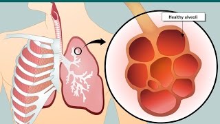 COPD and emphysema [upl. by Nico]