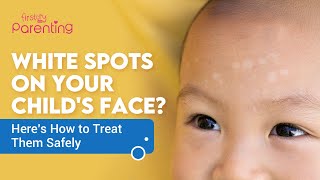 White Patches Or Spots On Childs Face  Causes and Treatments [upl. by Kcira]