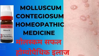 Homeopathic treatment of molluscum contegiosum मोलस्कम का होम्योपैथिक उपचार [upl. by Lindley514]